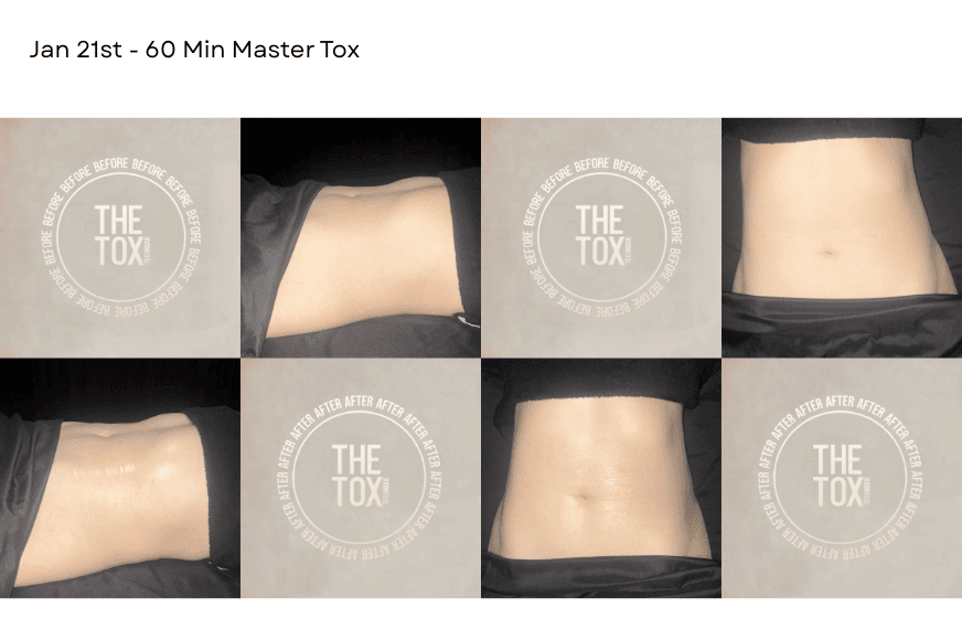 images of the stomach from the side and the top, before and after 60 min master tox treatment from The Tox in Chesterfield